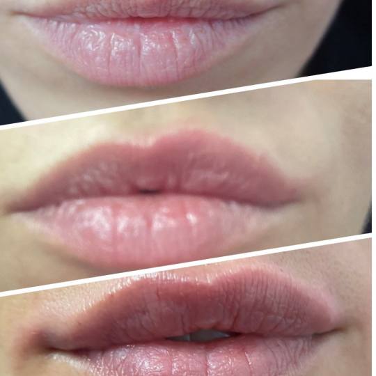 Blush Beauty Studio #beograd Hijaluronski tretmani lica Hijaluron Neauvia - 1 ml