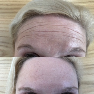 Botox - kompletan srednji deo lica - Ordinacija Stanojlović, Kruševac Kozmetički doktori Telo Kozmetički doktori, Kruševac, Centar