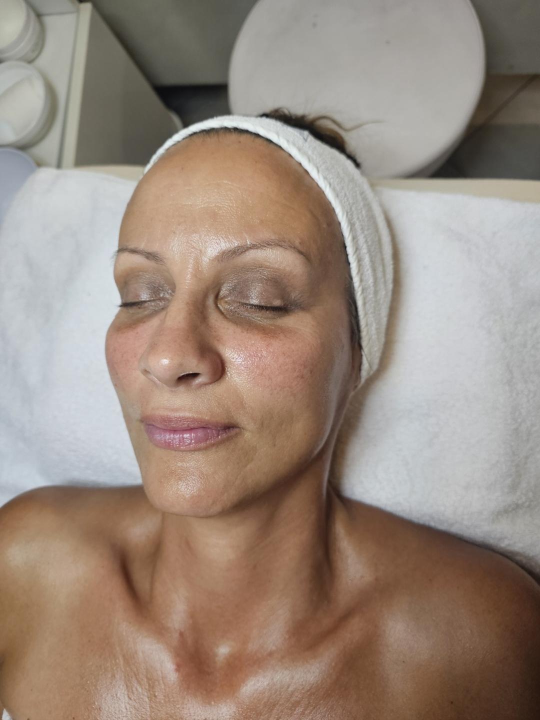 Choco Love #beograd Hijaluronski tretmani lica Oxy tretman lica kiseonikom