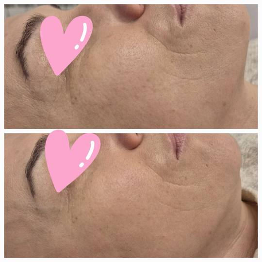 Happy Lady #beograd Trepavice Podmlađivanje lica egzozomima + dermapen Egzozomi nakon 1 tretmana