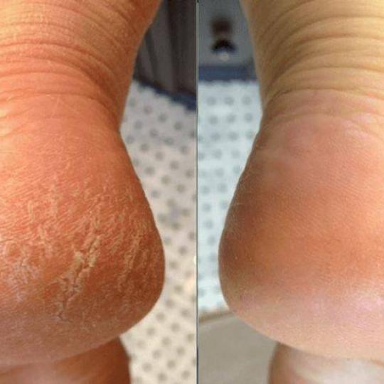 Princess beauty #nis Medicinski pedikir Medicinski pedikir - manje problematičan