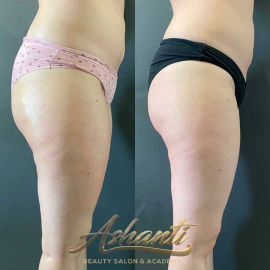 Ashanti Beauty Salon & Academy #beograd Kavitacija Pink ice body tretman - paket od 3 tretmana