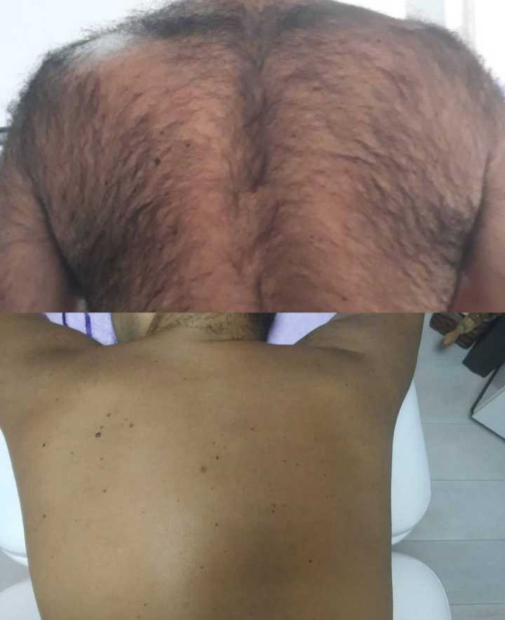 AltaBella Batajnica #beograd Laserska epilacija Laserska epilacija leđa - za muškarce