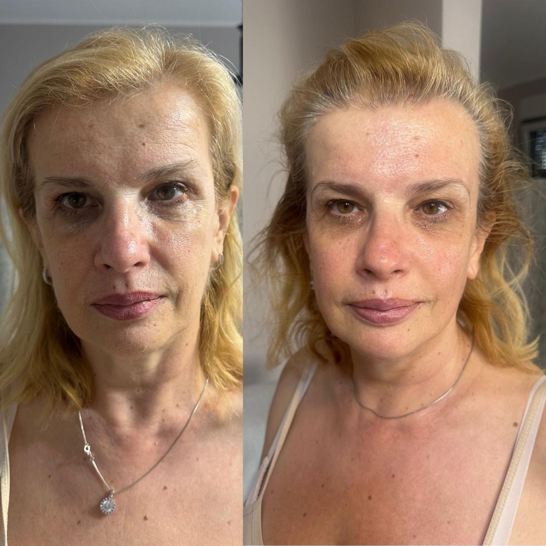 Masaža lica - face lifting - Amelie touch beauty, Beograd Masaža lica Lice Masaža lica, Beograd, Vračar, Čubura, Crveni krst
