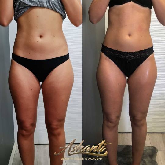Ashanti Beauty Salon & Academy #beograd Masaža za mršavljenje Dermapen - regija lica