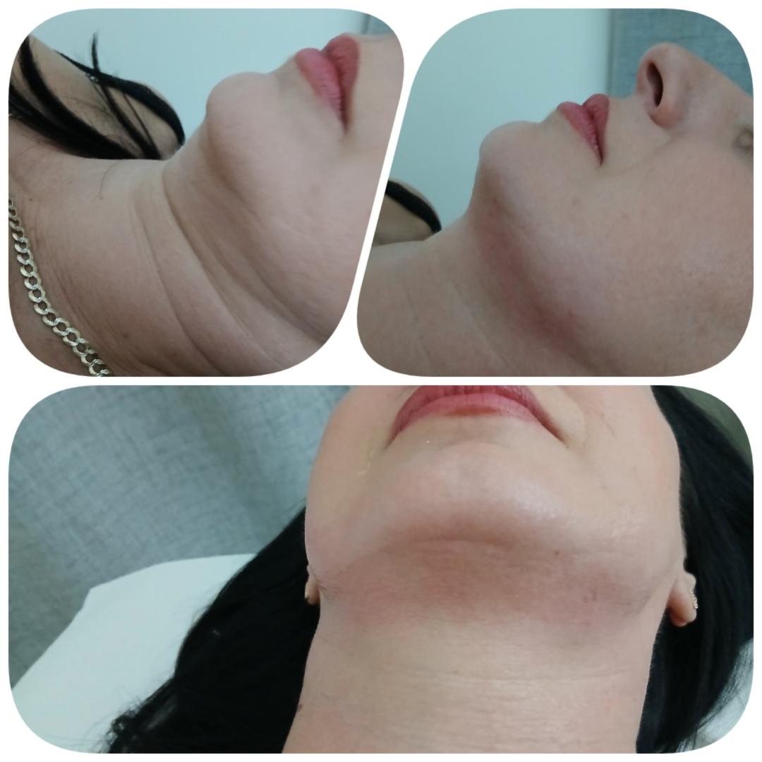 Happy in your body #beograd Tretman lica HIFU lice + podbradak + 2 Rolosfera tretmana lica