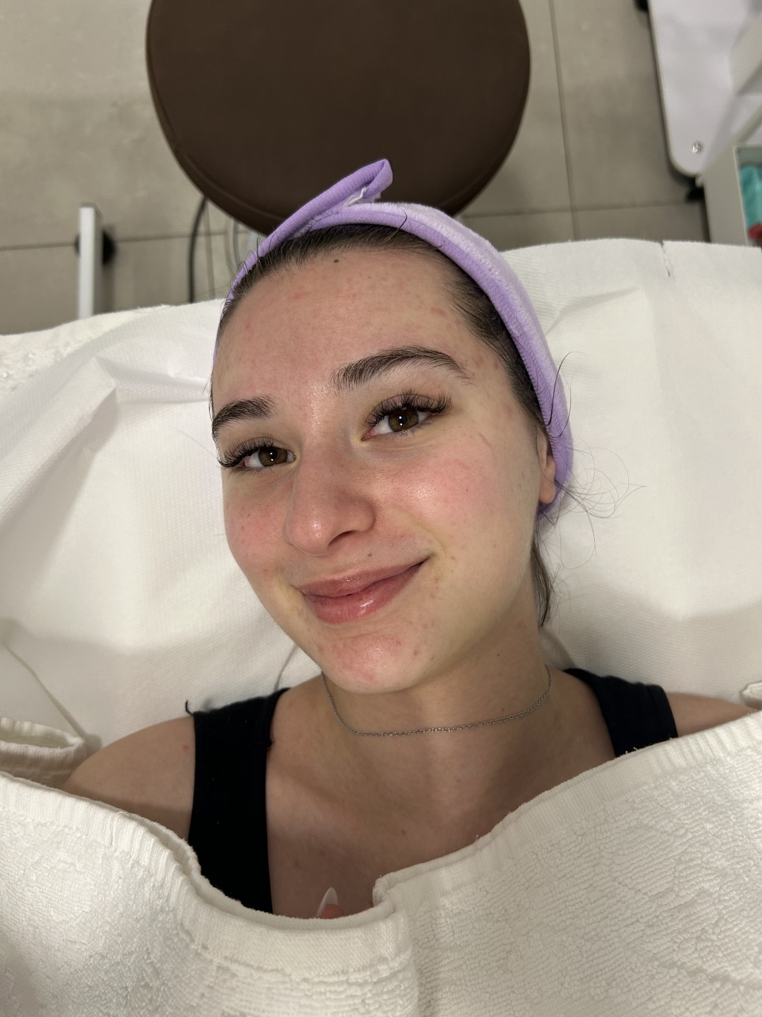 Hemijski piling lica - Sandra estetik studio, Beograd Tretman lica Lice Tretman lica, Beograd, Banovo brdo