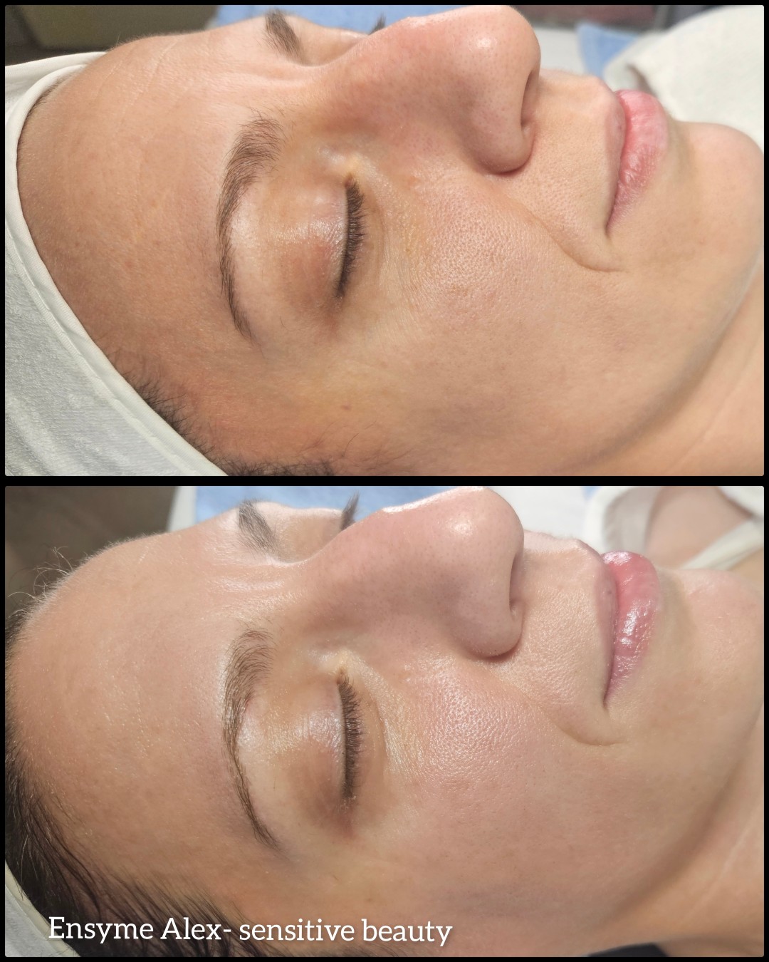 Beauty salon XL Lady #beograd Tretman lica Enzimski piling - Sensitive beauty