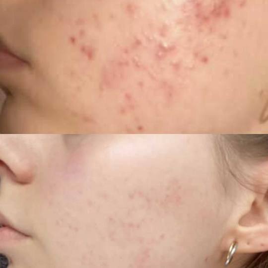 Contessa #novisad Tretman lica Acne stop