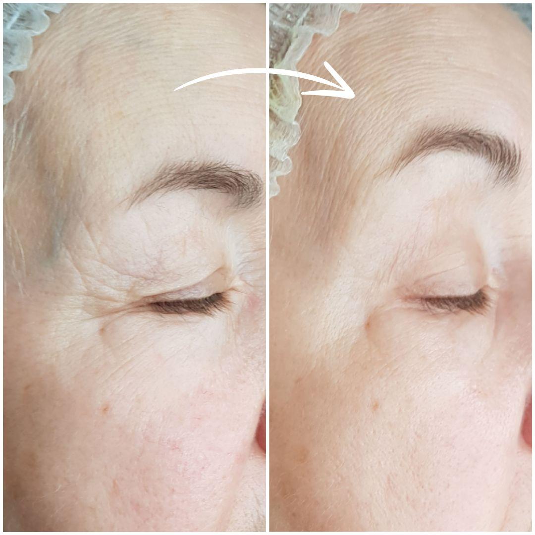 Angelique signature lift - Angelique beauty center, Beograd Lifting / zatezanje kože Lice Lifting / zatezanje kože, Beograd, Žarkovo, Cerak, Bele vode