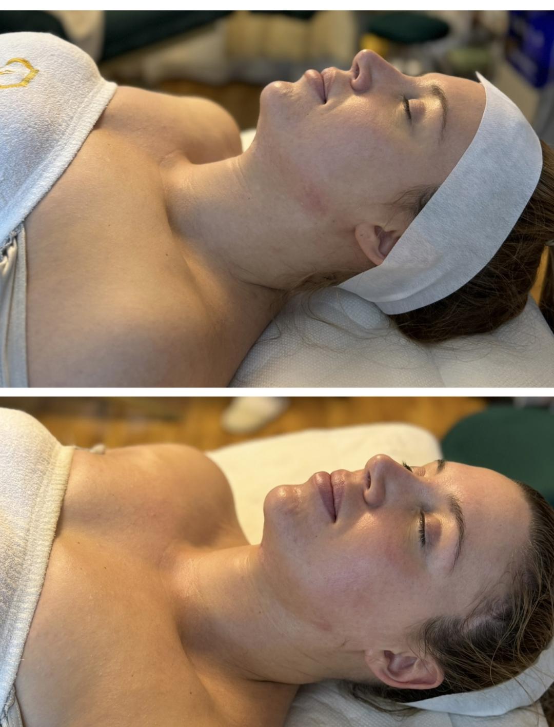 Beauty and nutrition #beograd Tretmani protiv bora Divine face-Limfnomodelovanje lica,vrata i dekoltea PAKET 5 tretmana