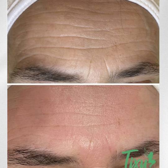 Tixy - Veternik #novisad Dermaroler i dermapen Dermapen tretman lica + derma serum Dermapen je apara