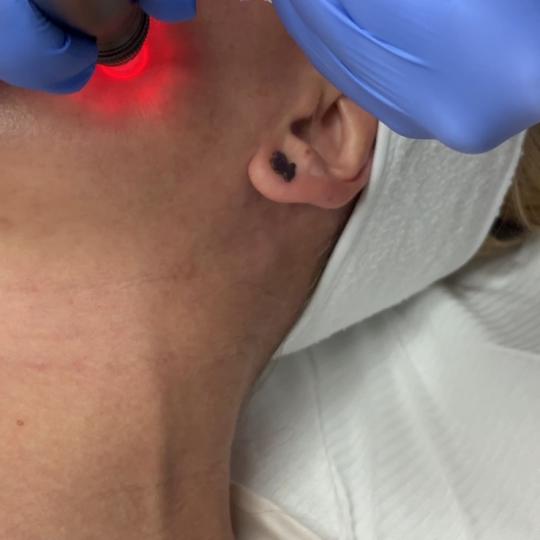 Estetik MPL 87 #beograd