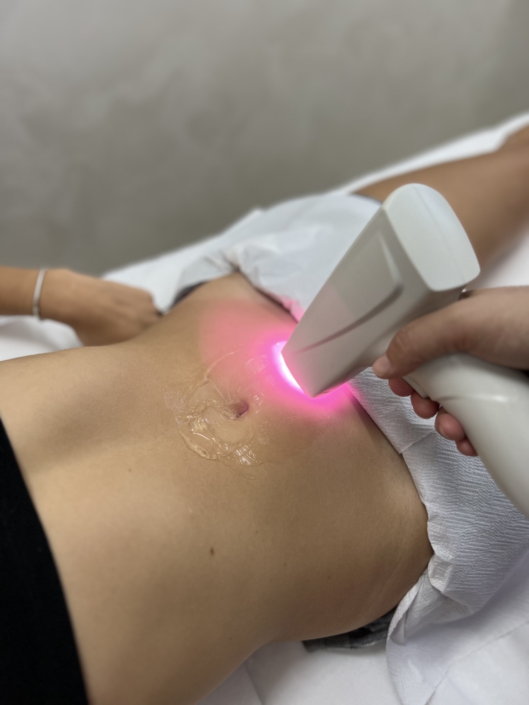 GM Beauty studio #beograd Laserska epilacija Laserska epilacija celog stomaka - za dame
