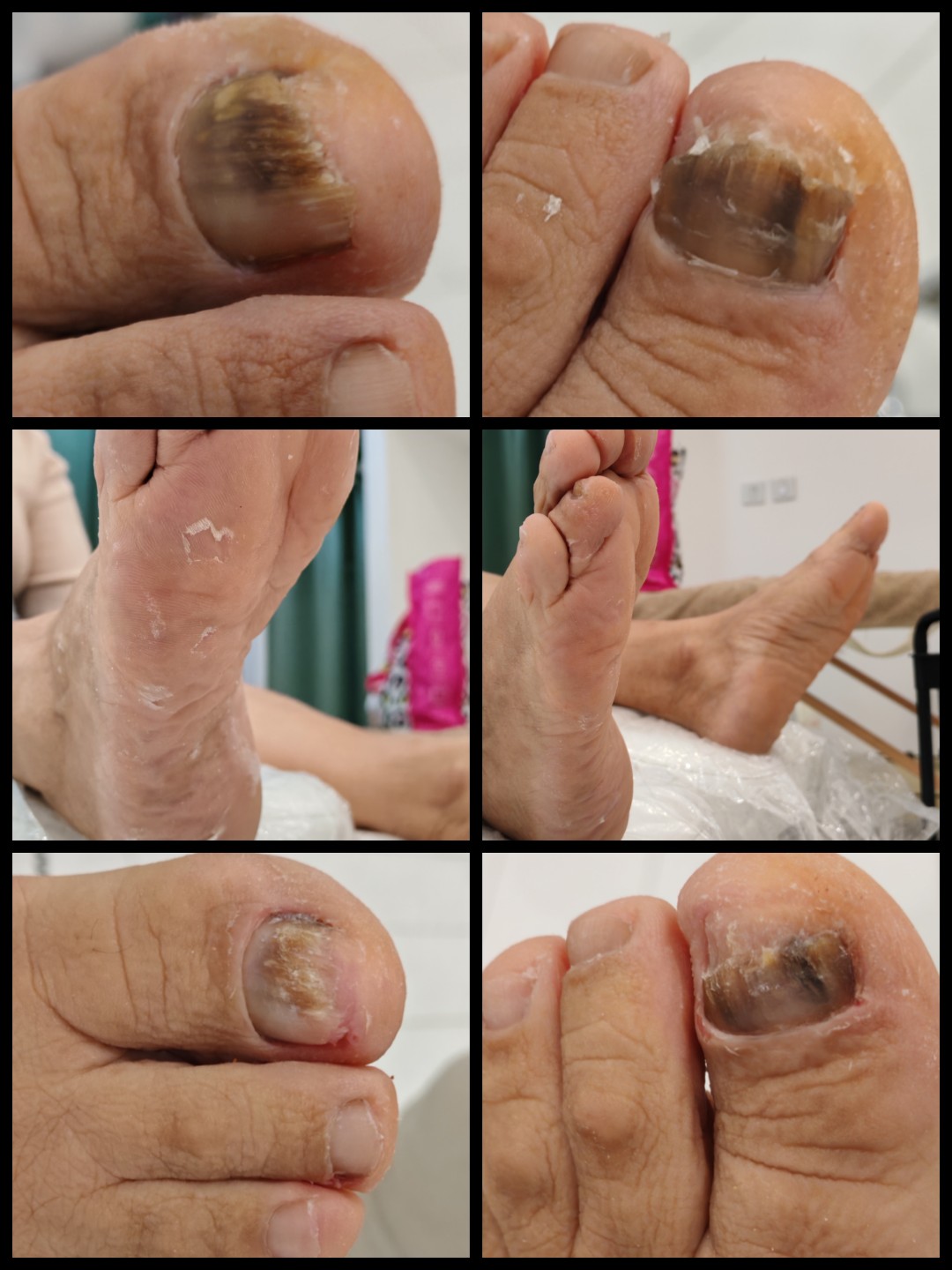 Medicinski pedikir - Micy wallker studio, Požarevac Medicinski pedikir Nokti Medicinski pedikir, Požarevac, Centar