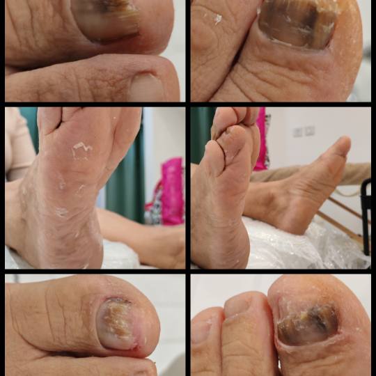 Micy wallker studio #pozarevac Medicinski pedikir Medicinski pedikir