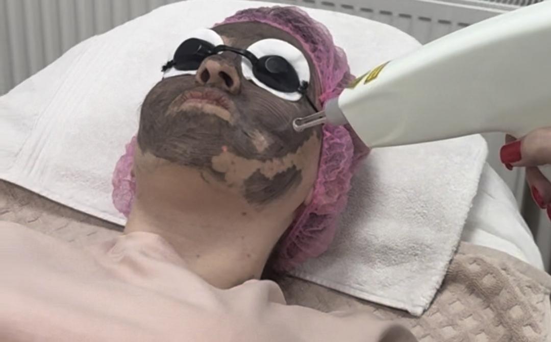 Vojin #beograd Tretman lica Carbon laser peel - holivudski piling