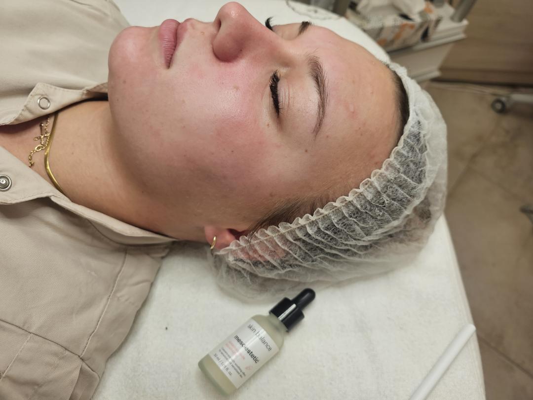 Choco Love #beograd Dermaroler i dermapen Dermapen tretman + Hemijski piling