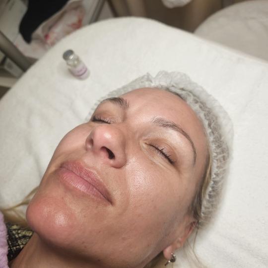 Choco Love #beograd Tretman lica PRX therapy PRX-T33 je poseban hemijski piling nove generacije koji