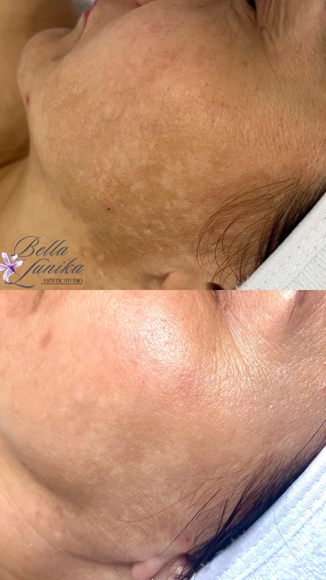 Mesopeel terapija lica - paket od 3 tretmana - Bella Lunika Estetic studio, Pančevo Tretman lica Lice Tretman lica, Pančevo, Centar