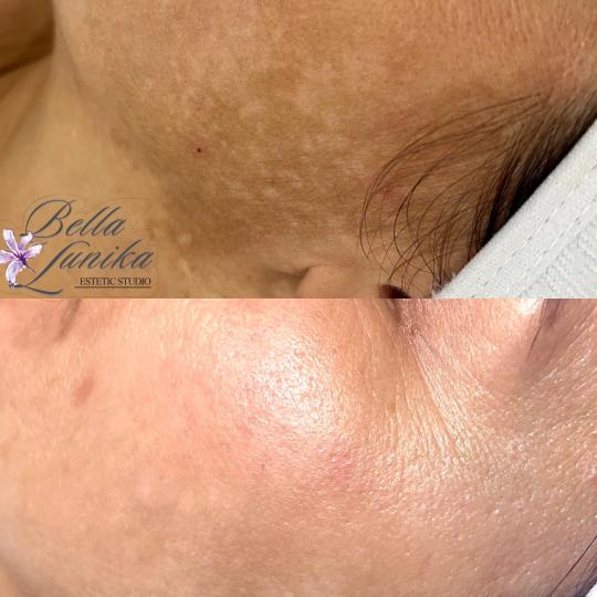Bella Lunika Estetic studio #pancevo Tretman lica Mesopeel terapija lica - paket od 3 tretmana Hiper