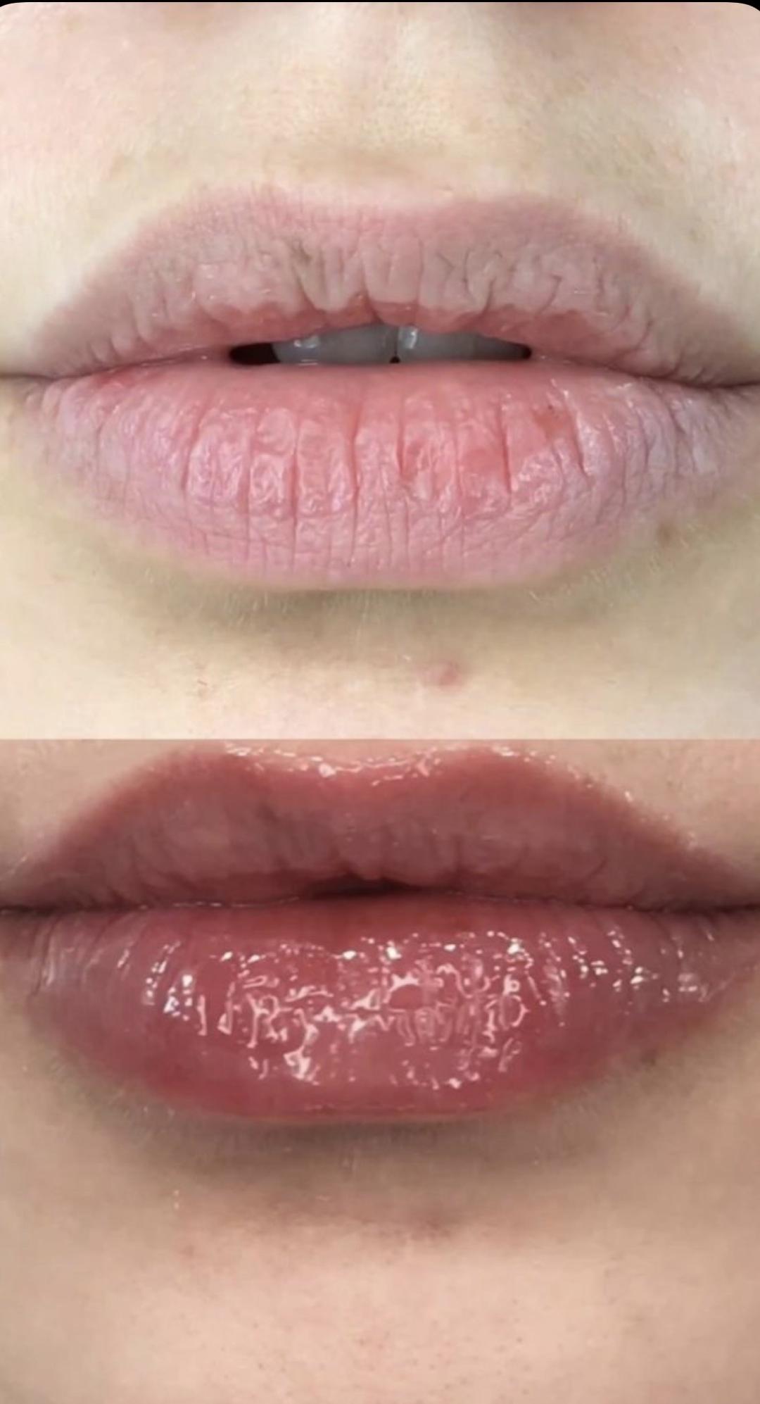 Amelini beauty concept #beograd Hijaluronski tretmani lica Amelini lips