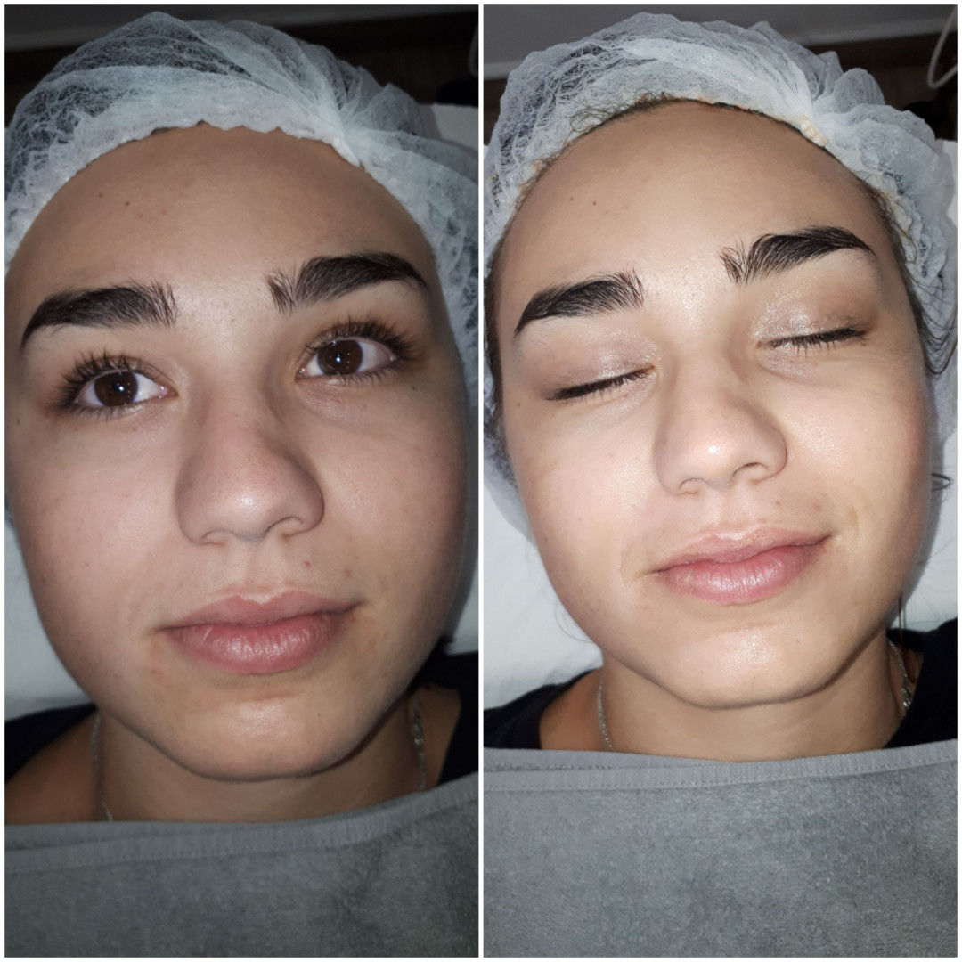 Essence of Beauty Academy #beograd Tretman lica Karbonski tretman lica