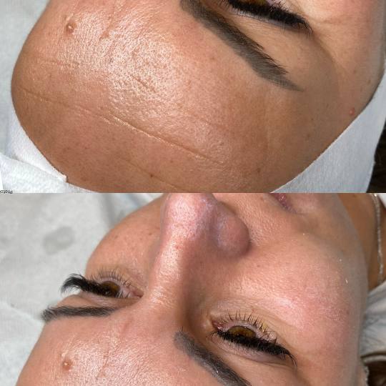 Beauty and nutrition #beograd Lifting / zatezanje kože Kolagen trake+kolagen niti+botox maska