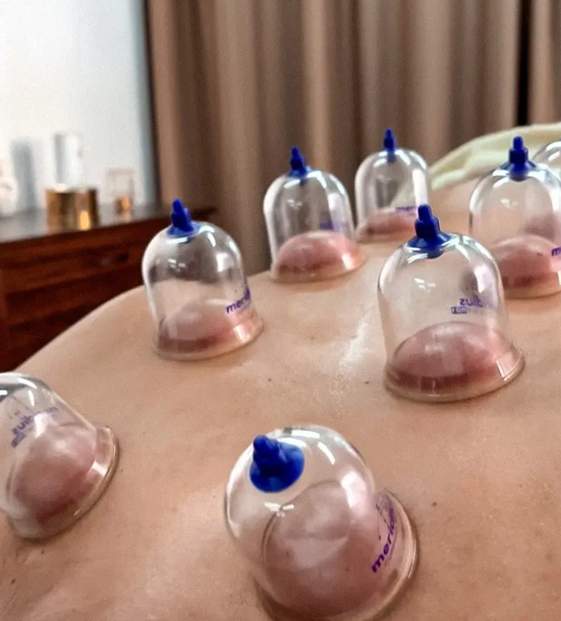 Kinefiz #beograd Masaža teglama Cupping masaža