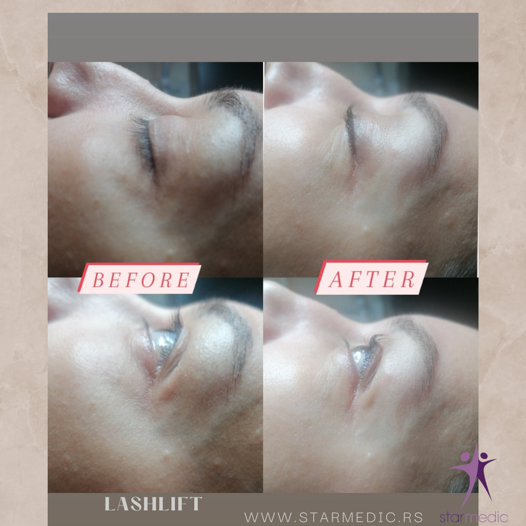 Starmedic #beograd Trepavice Minival trepavica