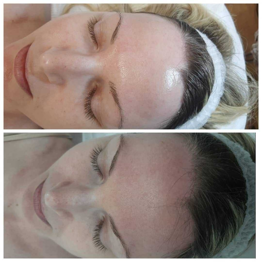 Felicita #beograd Tretman lica Hydro Pro Facial 7in1