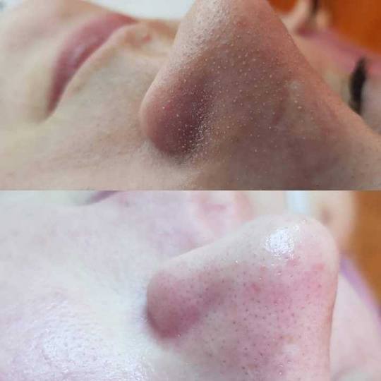 Estetic studio Ognjanović #beograd Tretman lica Osnovni higijenski tretman lica