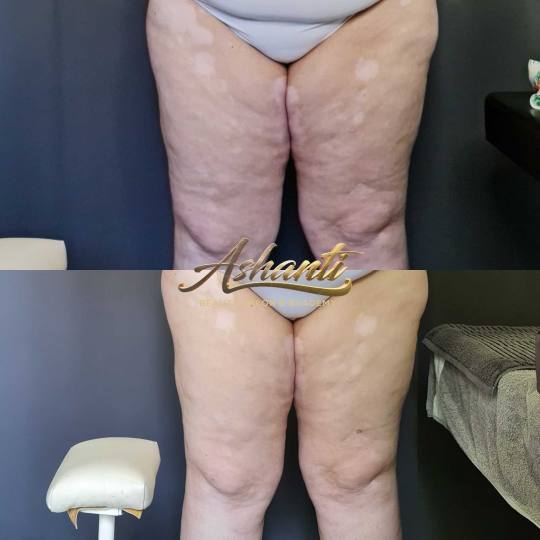 Ashanti Beauty Salon & Academy #beograd Tretmani za mršavljenje Vacuslim 48 - noge + stomak + ruke 