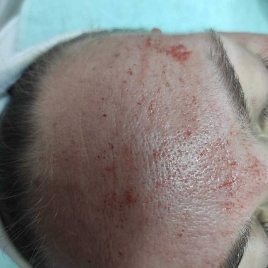 2 Cats 1 #beograd Dermaroler i dermapen Dermapen lice + vrat