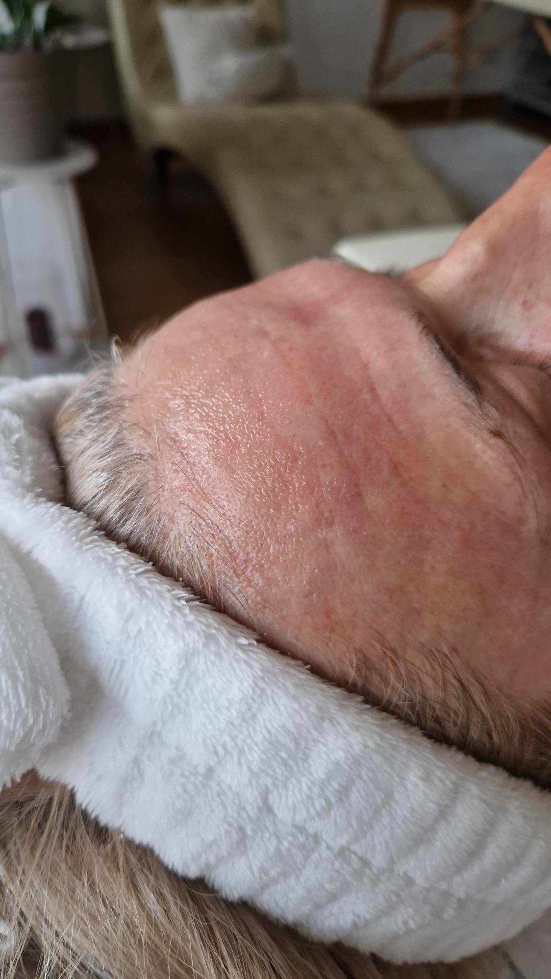 Dermapen - lice + vrat + dekolte - Glow Holistic Studio, Beograd Dermaroler i dermapen Lice Dermaroler i dermapen, Beograd, Novi Beograd blokovi, Belville, Savski kej