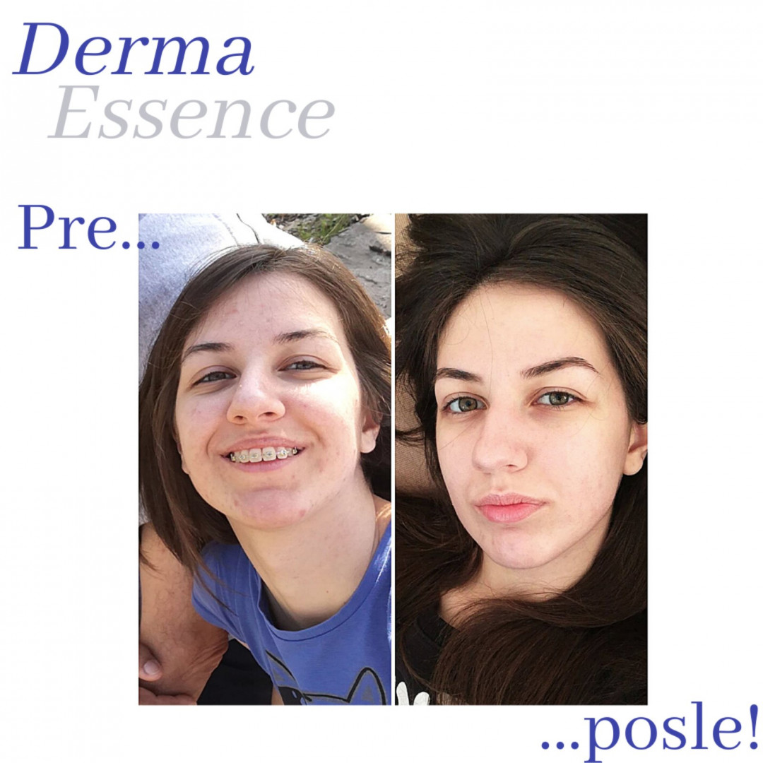 Derma Essence #nis Tretman lica Osnovni higijenski tretman lica