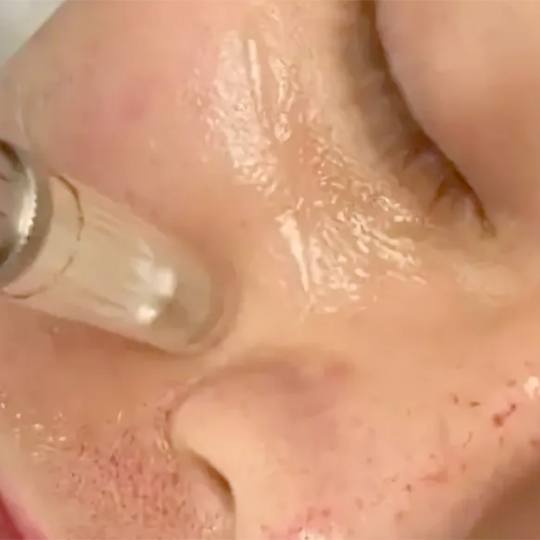 Beauty and me #novisad Tretman lica Mezoterapija (sa dermapenom)- Tretman protiv pigmentacije Mezote
