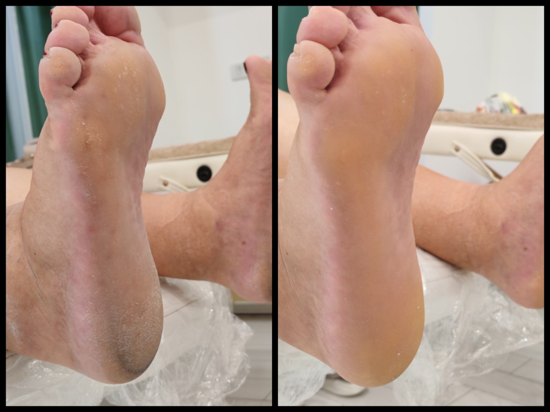 Medicinski pedikir - Micy wallker studio, Požarevac Medicinski pedikir Nokti Medicinski pedikir, Požarevac, Centar