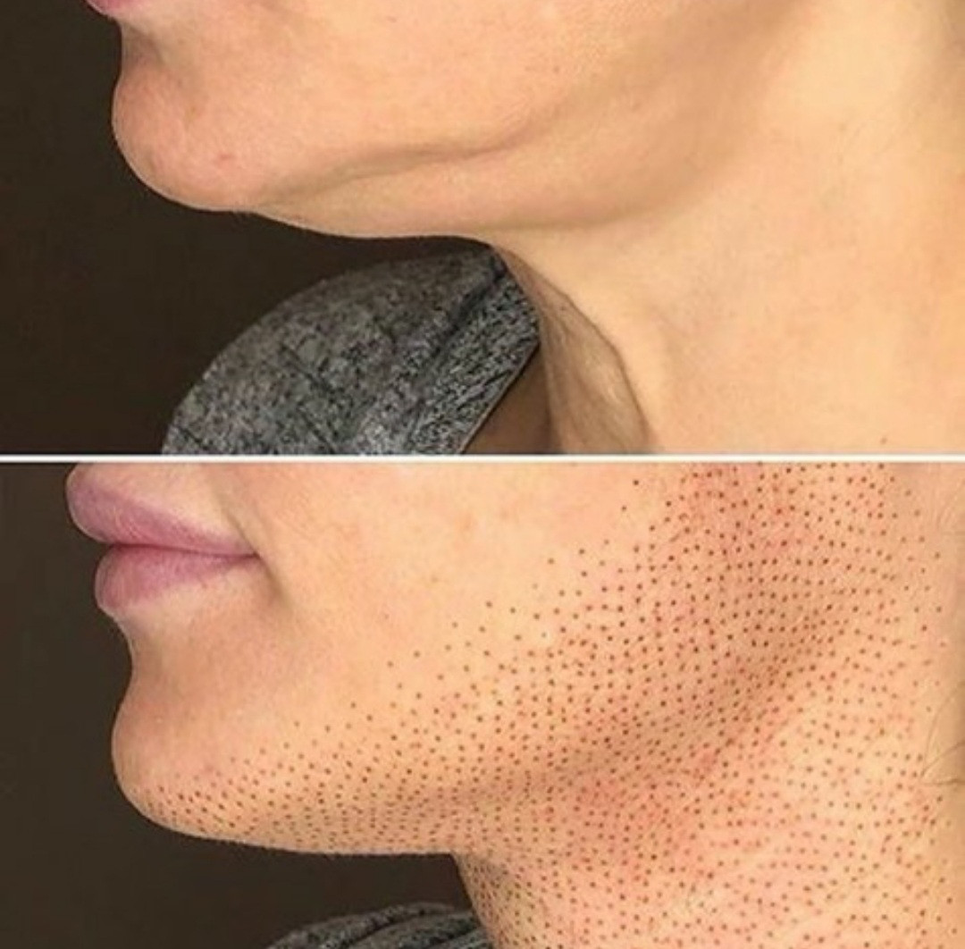 Vila Beauty Studio #beograd Tretman lica Plasma pen (po regiji)