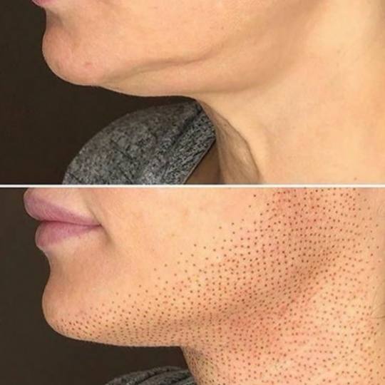 Vila Beauty Studio #beograd Tretman lica Plasma pen (po regiji)