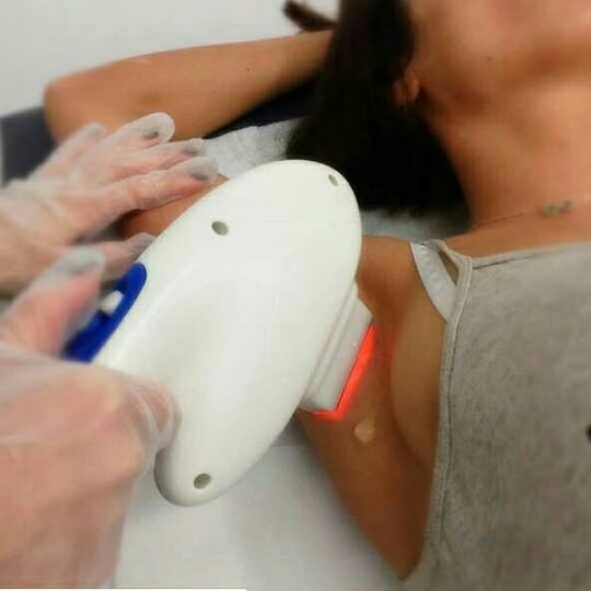Chic & Unique #beograd Epilacija IPL aparatom Trajno rešenje za neželjene dlačice Epilacija pazuh
