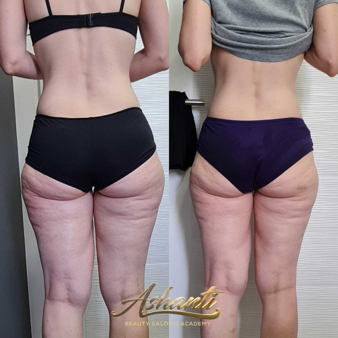 Ashanti Beauty Salon & Academy #beograd Masaža za mršavljenje Dermapen - regija lica
