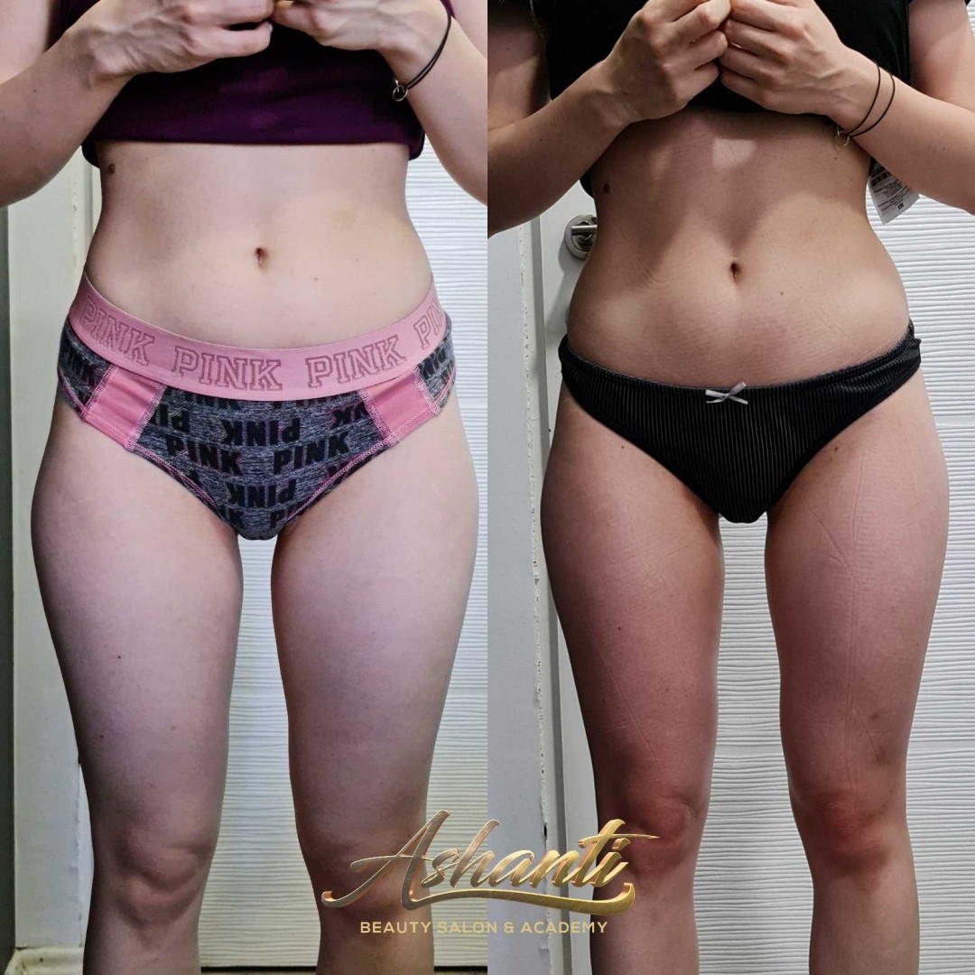 Ashanti Beauty Salon & Academy #beograd Masaža za mršavljenje Dermapen - regija lica