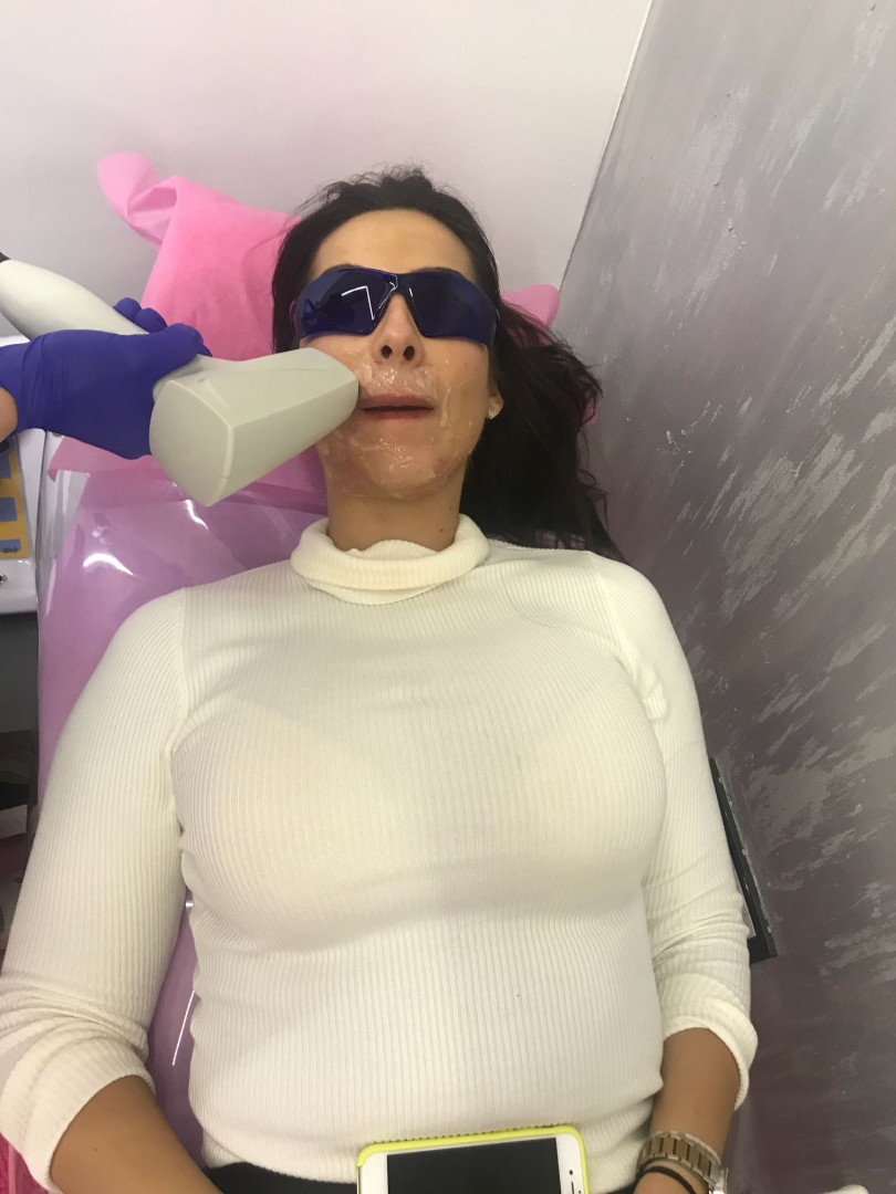 Body Beauty Balance 2020 #beograd Laserska epilacija