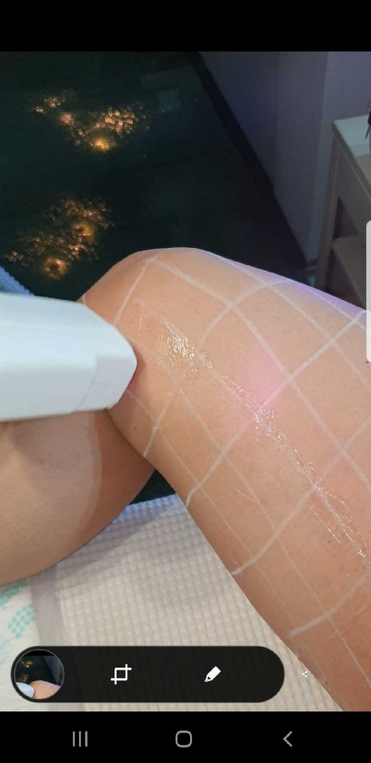 Grossi cosmetic #beograd Laserska epilacija