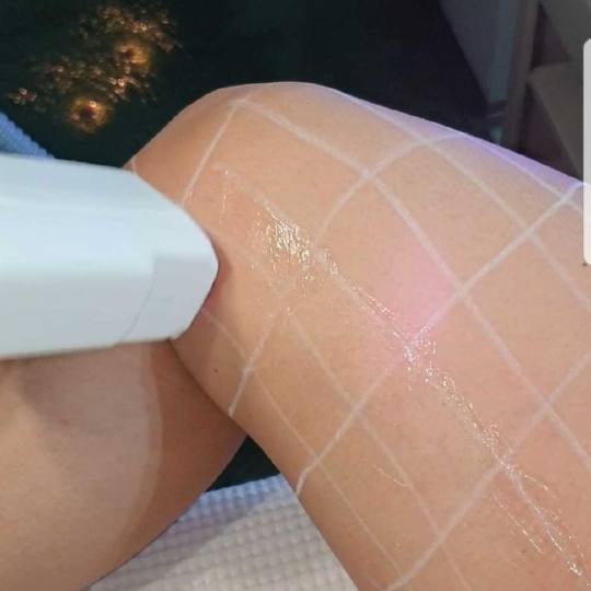 Grossi cosmetic #beograd Laserska epilacija