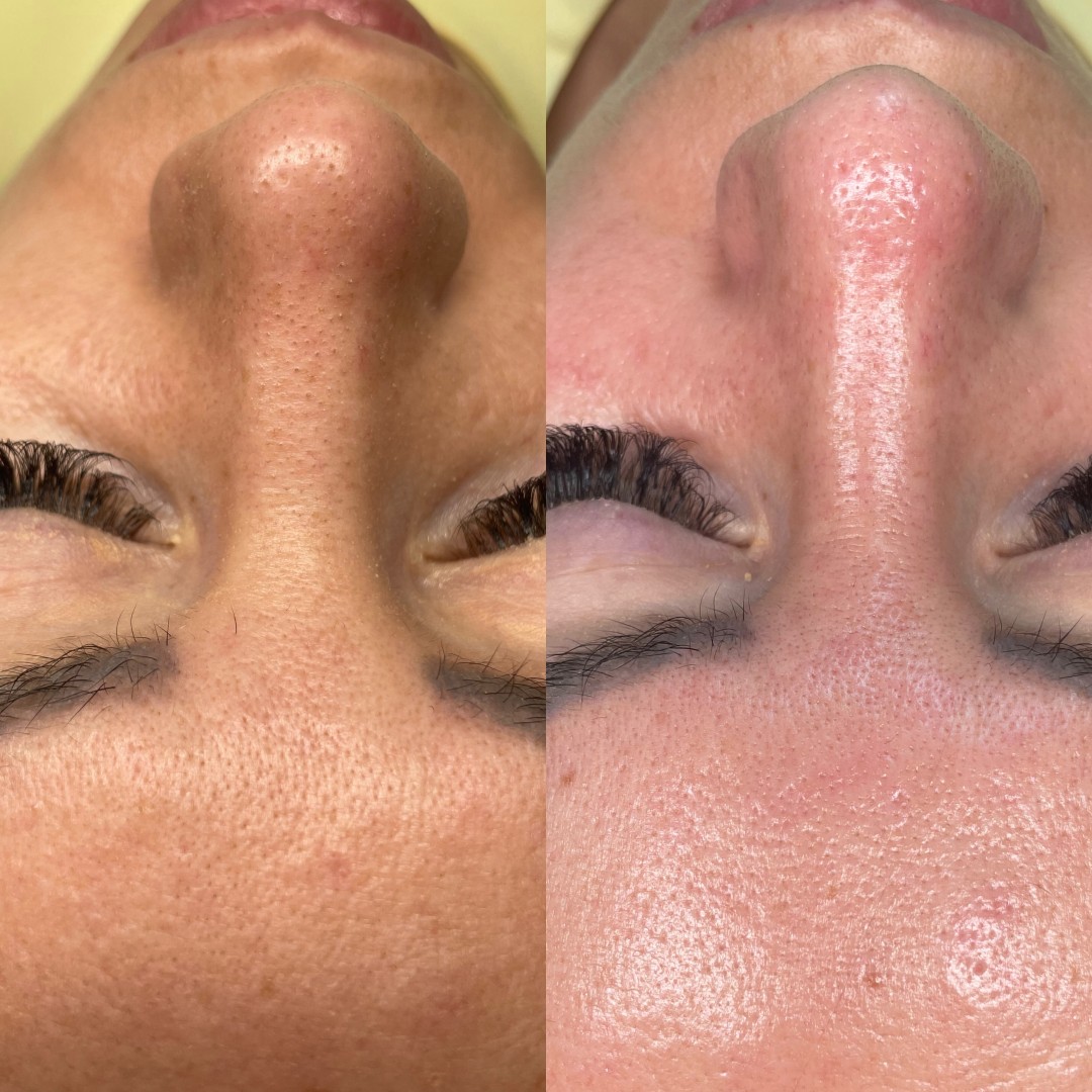 ReNova nutri & beauty #beograd Tretman lica Hidrafacial + oxy jet