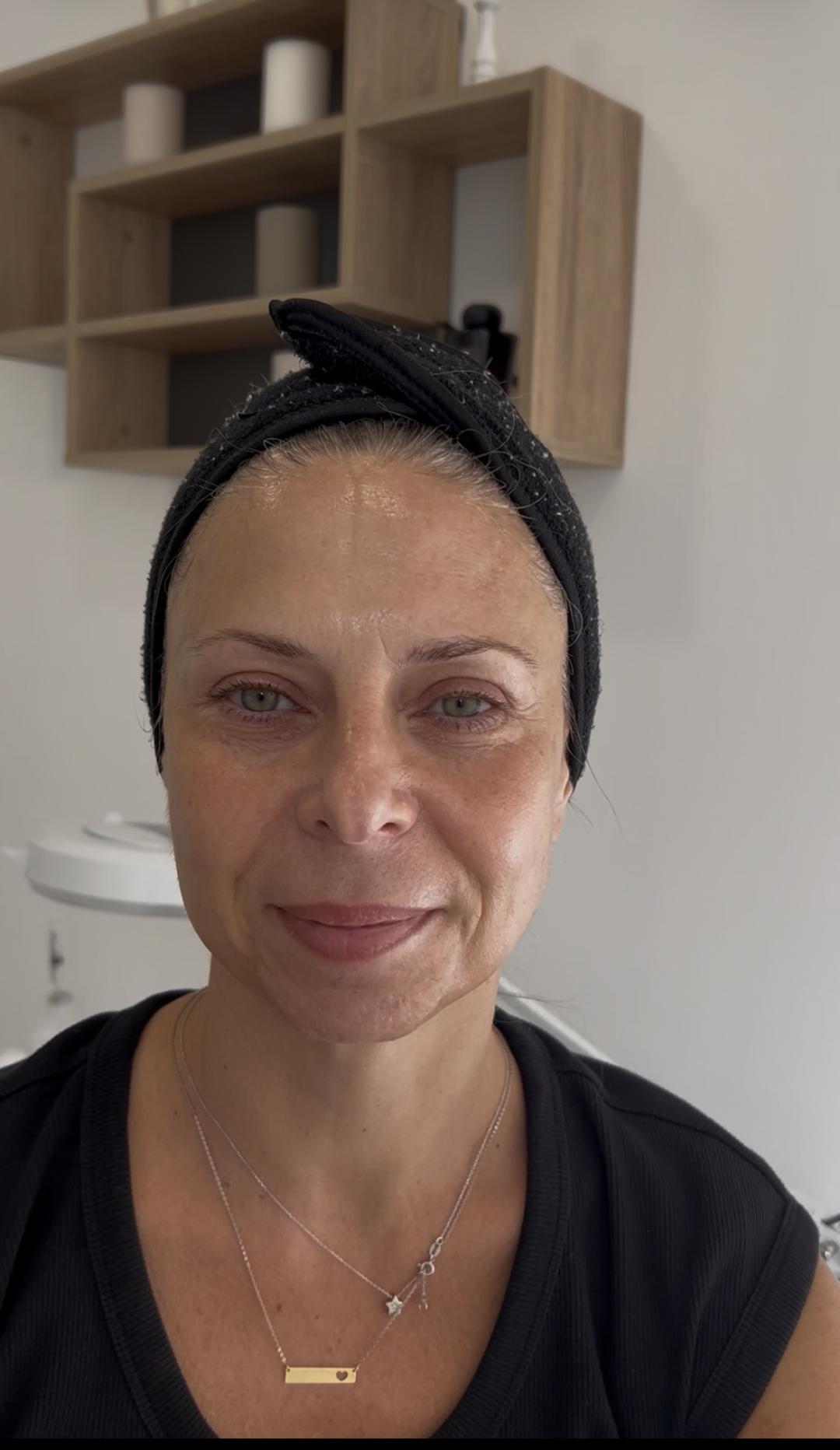 Biodroga skin reset collagen peel - Sandra estetik studio, Beograd Tretmani protiv bora Lice Tretmani protiv bora, Beograd, Banovo brdo