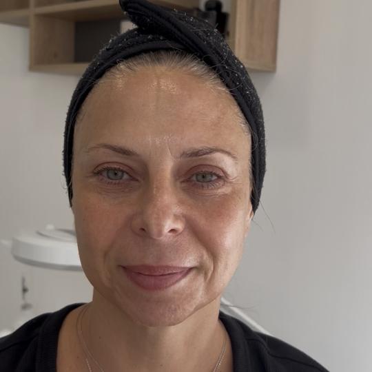 Sandra estetik studio #beograd Tretmani protiv bora Biodroga skin reset collagen peel 🌿 Hvala na 