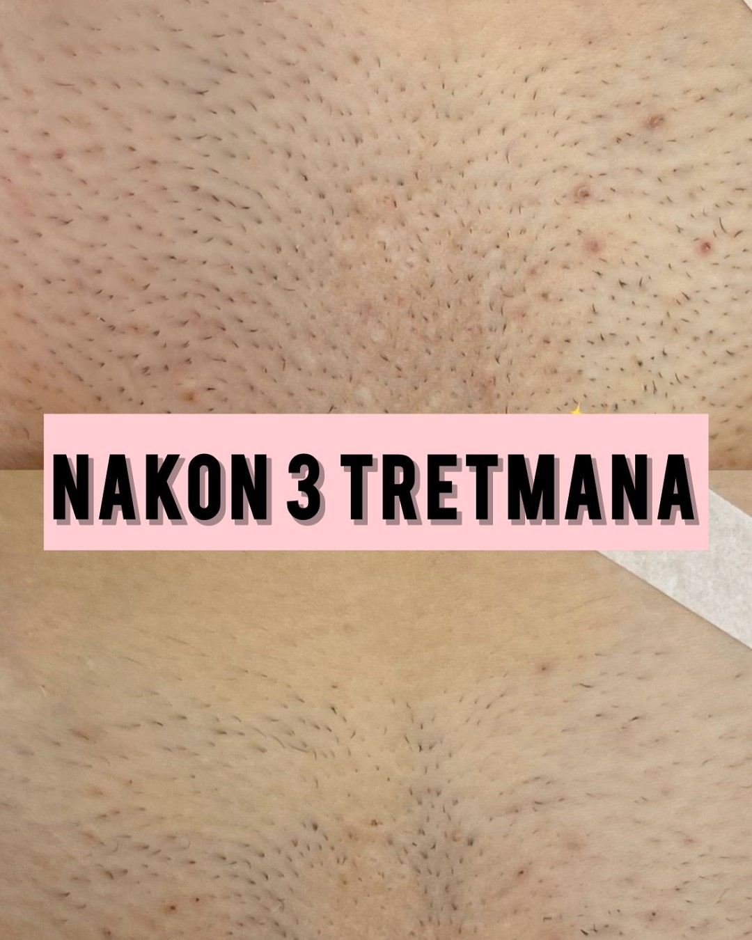 Boho Beauty #beograd Laserska epilacija Laserska epilacija brazilke - za dame